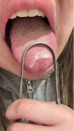 Close-up of a person using a stainless steel tongue scraper